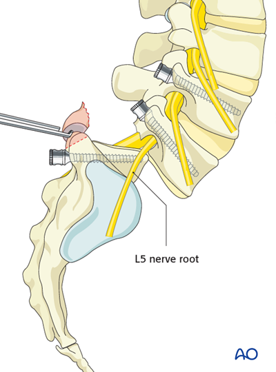 Posterior fusion of L5-S1 for Spondylolisthesis - Type 5