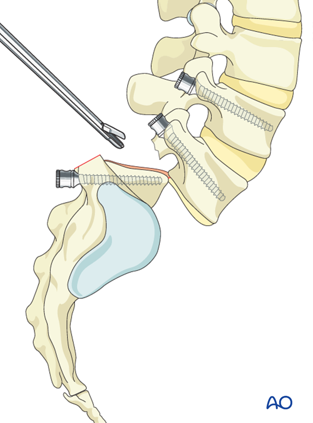 posterior fusion of l5 s1