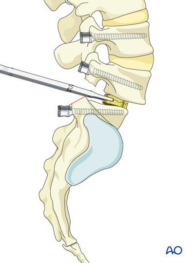 Posterior fusion of L5-S1 for Spondylolisthesis - Type 5