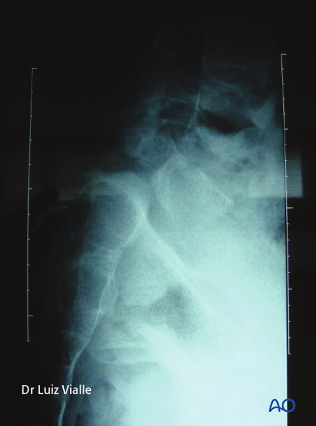 posterior fusion of l4 s1 with or without pelvic fixation or ala