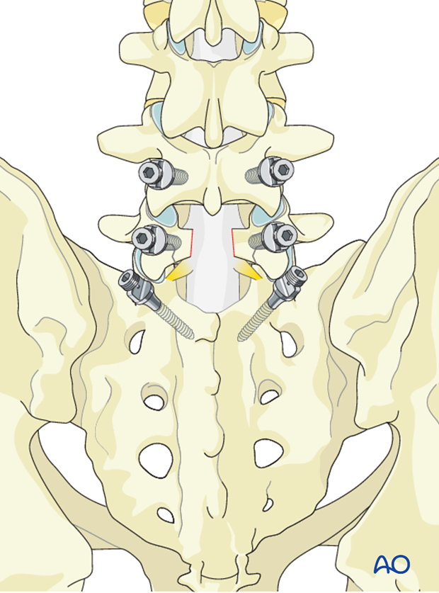 posterior fusion of l4 s1 with or without pelvic fixation or ala