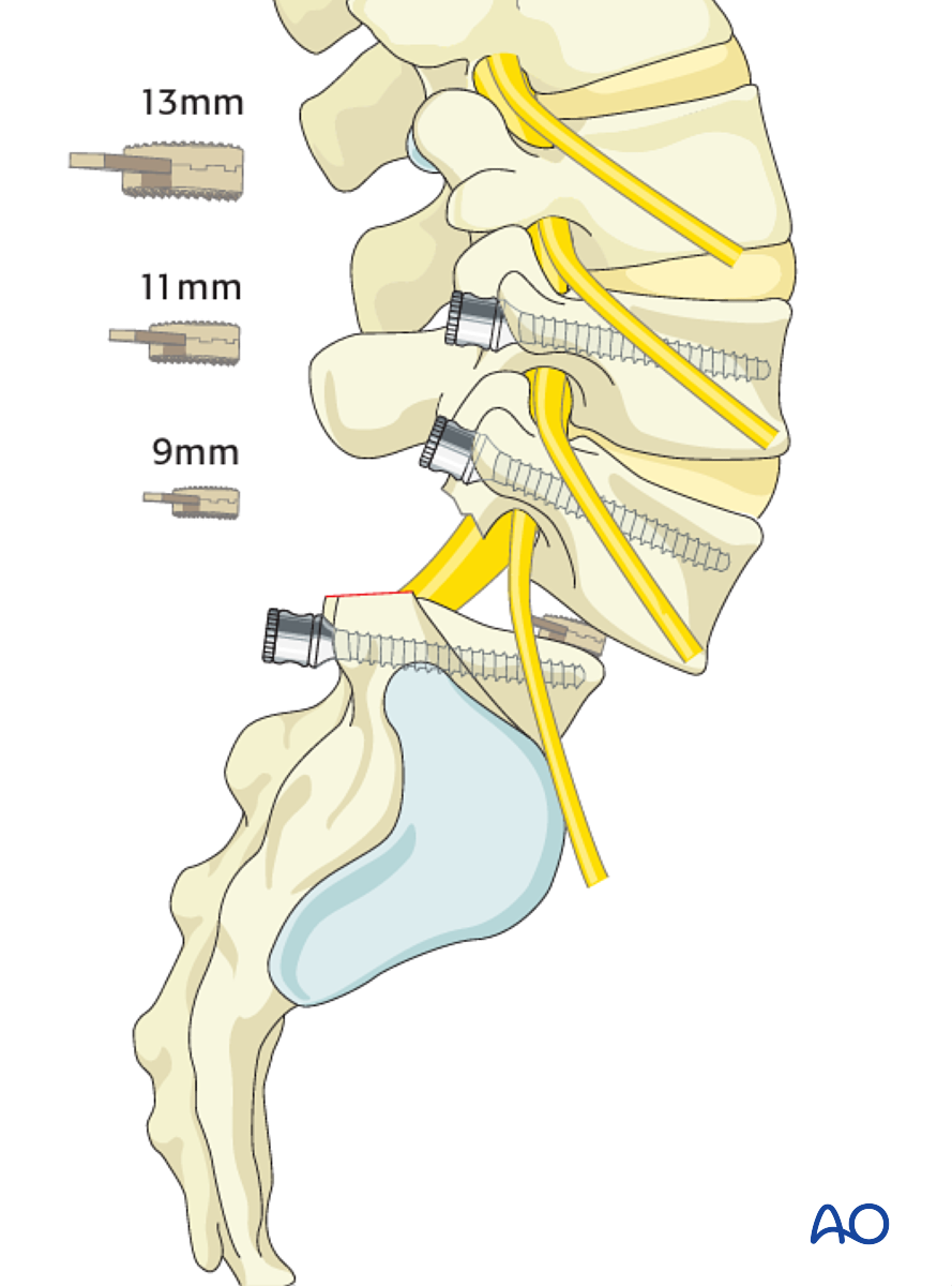 L4 L5 Back Fusion