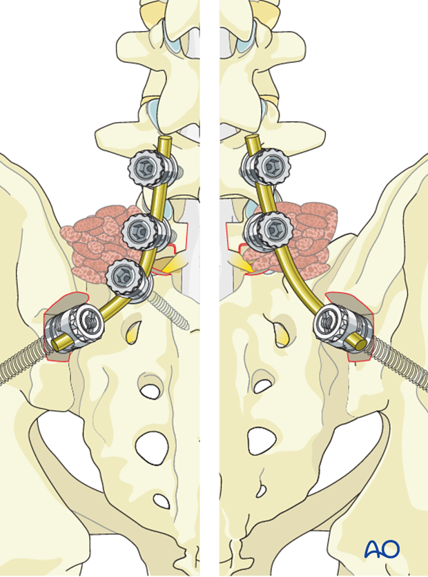 posterior fusion of l4 s1 with or without pelvic fixation or ala