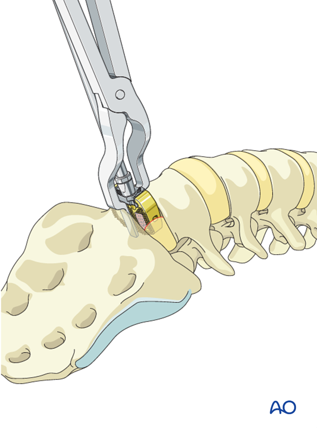 anterior fusion of l5 s1