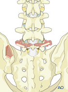 spondylolisthesis type 1