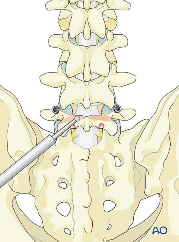 primary repair with pedicle screw and rod