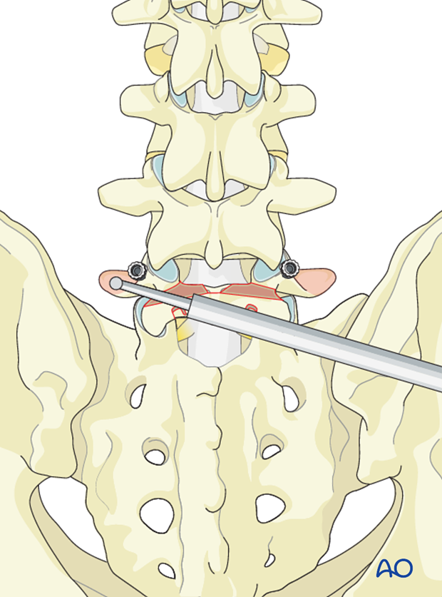 primary repair with pedicle screw and rod