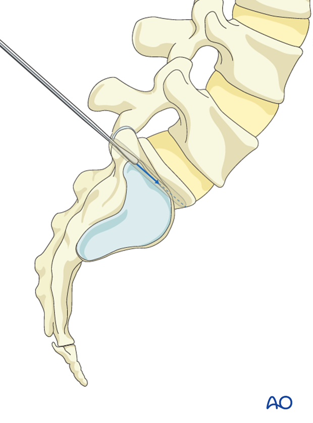 Cranial-caudal angulation of S1 pedicle screw