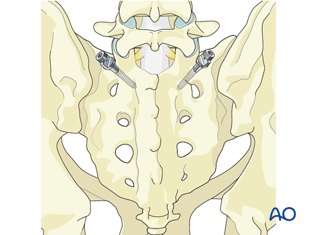 S1 pedicle screw insertion