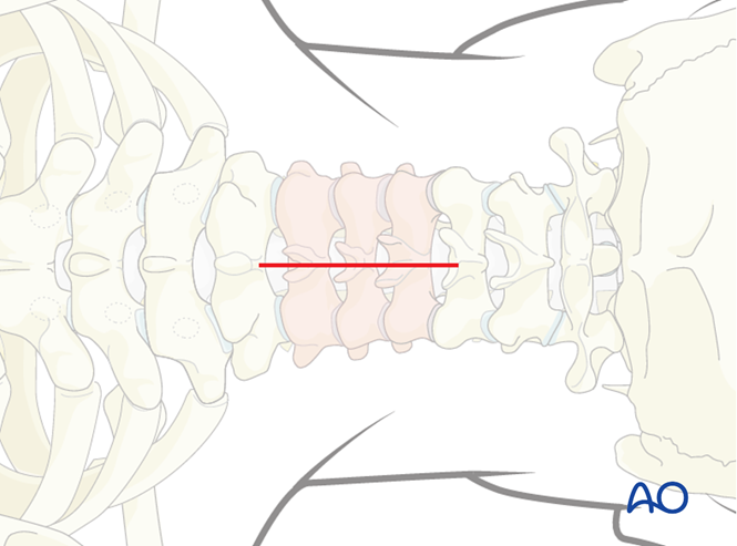 Posterior decompression and stabilization C3-C7 for Subaxial cervical ...