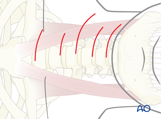 The transverse incision is made at the level required. 