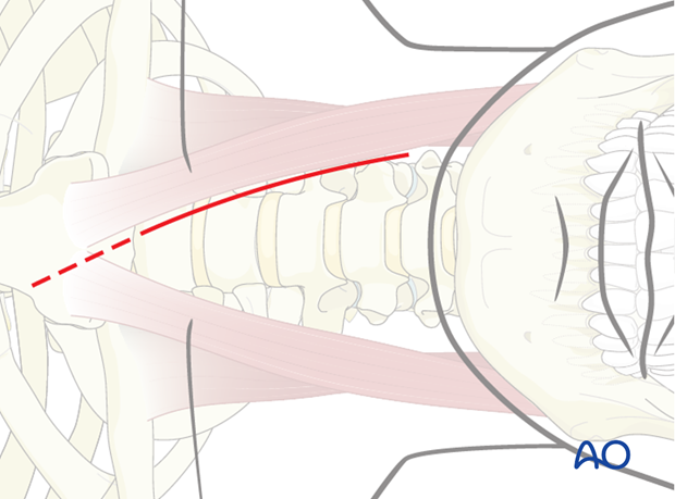 If a multilevel fixation is considered, a more longitudinal incision is required.