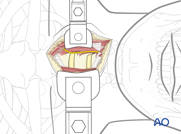 The recurrent laryngeal nerve is identified and protected.