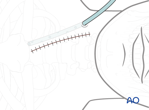 A wound drain is inserted through a separate stab incision.
