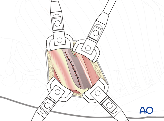 Left sided thoracotomy (T3-L1/2)
