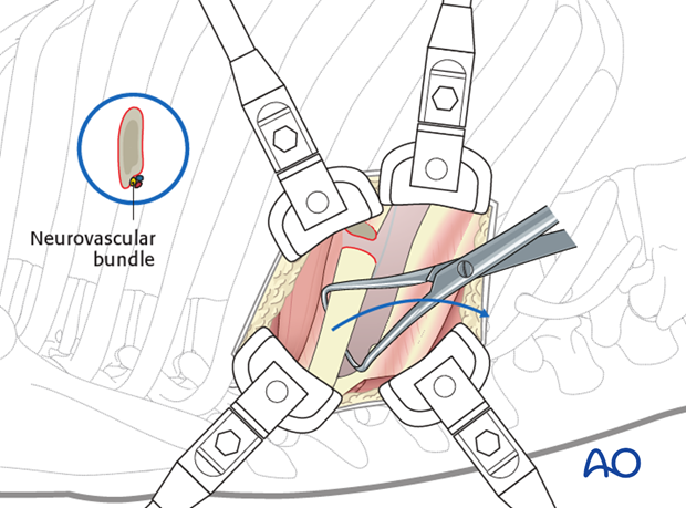 Thoracic and lumbar pathologies: Right sided thoracotomy (T3-T10)