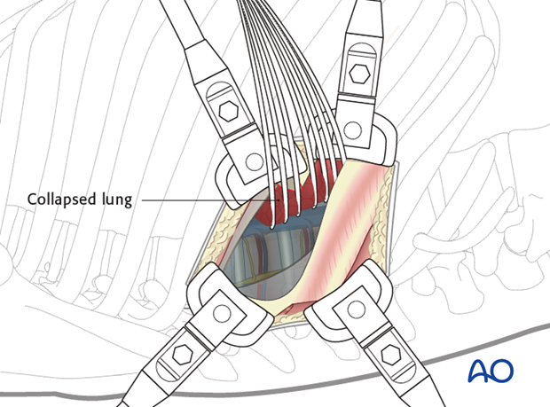 Thoracic and lumbar pathologies: Right sided thoracotomy (T3-T10)