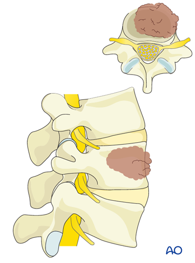 Stable spine – Low grade ESCC
