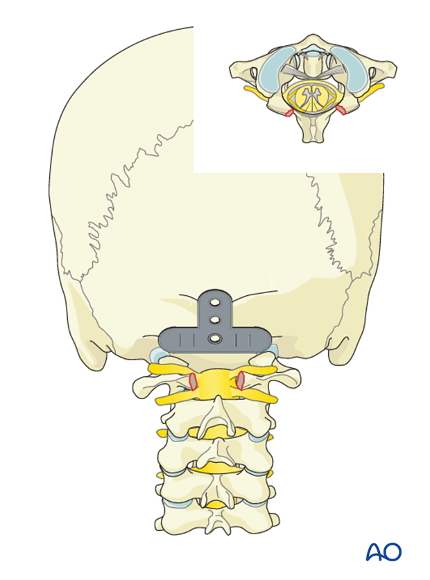 occipitocervical fusion