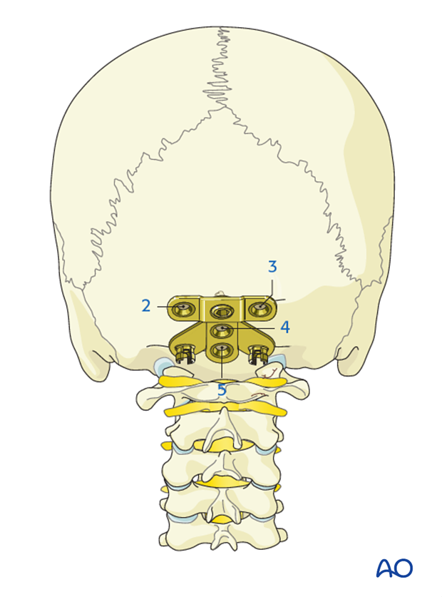 occipitocervical fusion