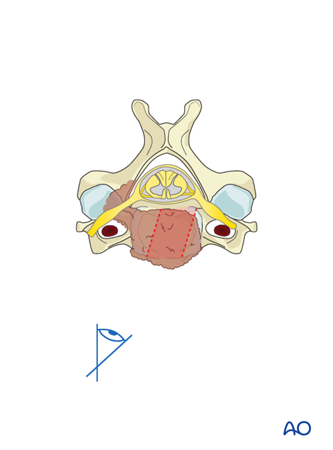 Anterior corpectomy and stabilzation for Subaxial cervical, unstable ...