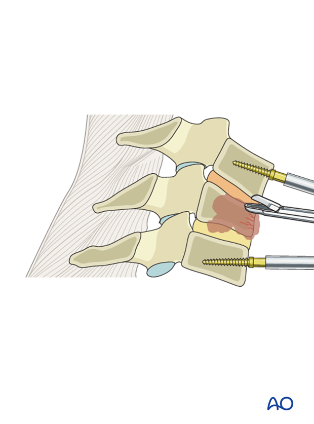 anterior corpectomy and stabilzation
