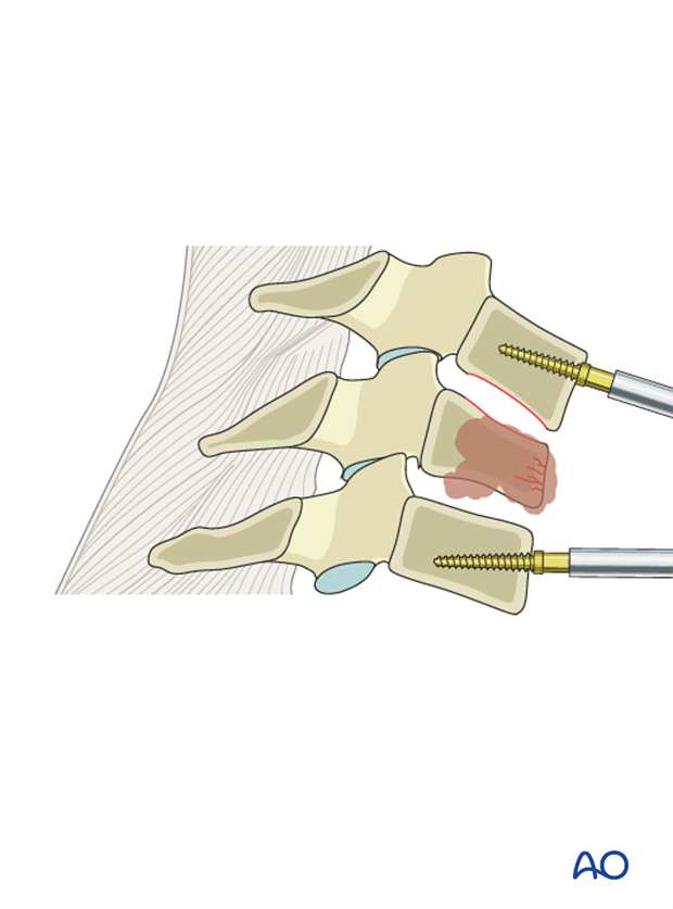 anterior corpectomy and stabilzation