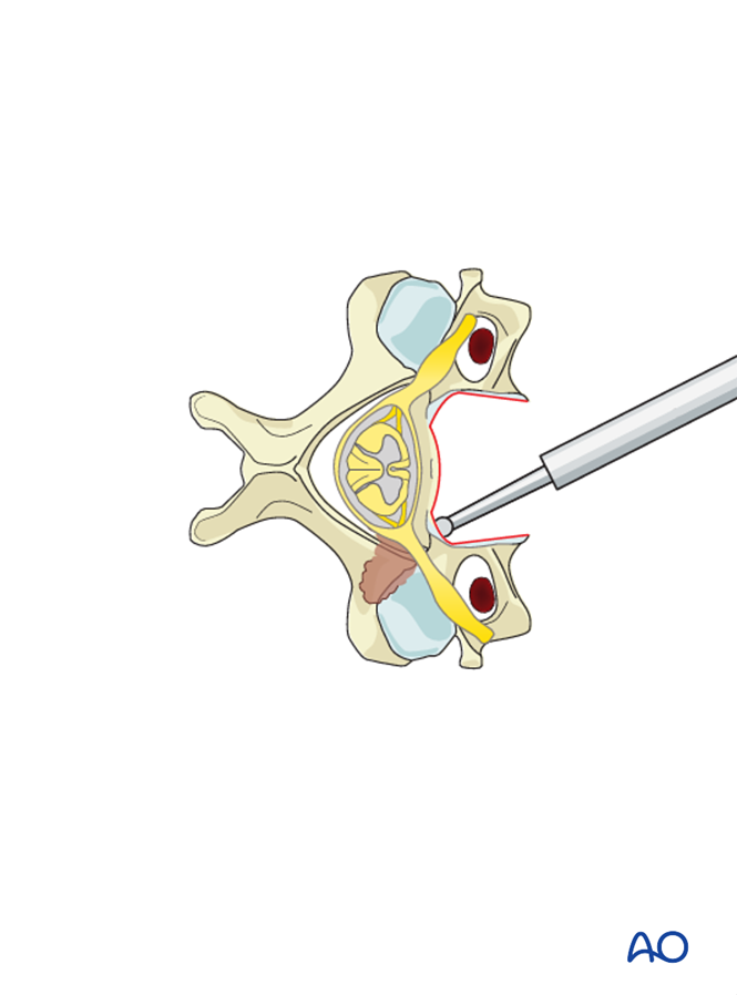 Anterior decompression and stabilization for Subaxial cervical, stable ...