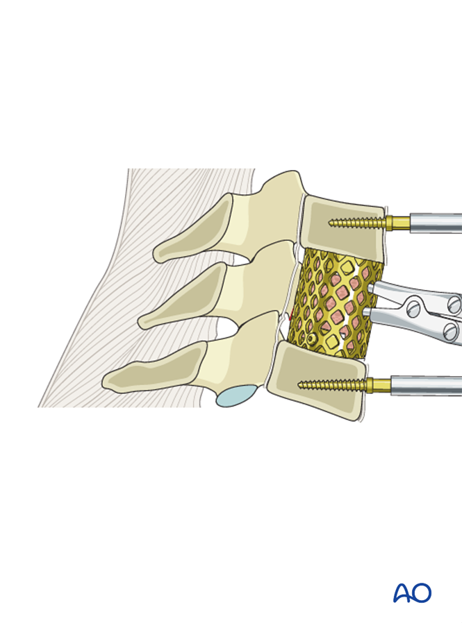 Anterior decompression and stabilization for Subaxial cervical, stable ...