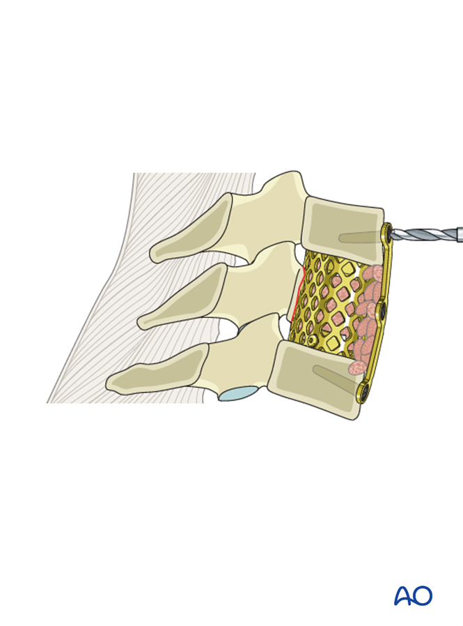 Anterior corpectomy and stabilzation for Subaxial cervical, unstable ...
