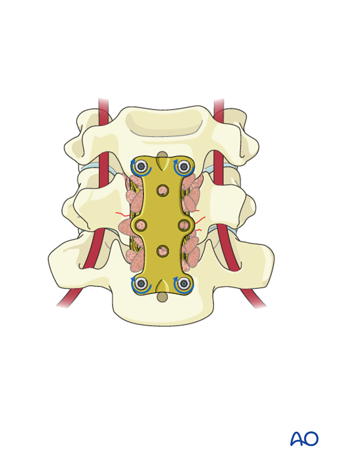 Anterior corpectomy and stabilzation for Subaxial cervical, unstable ...