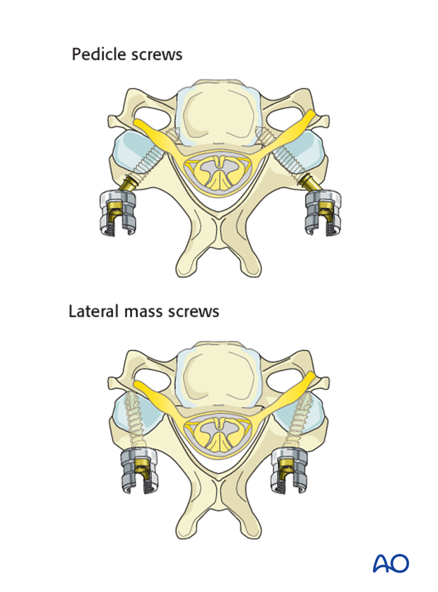 Pedicle screws and lateral mass screws