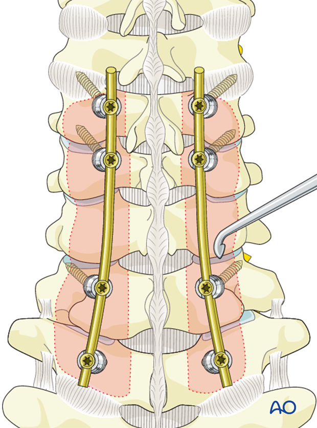 posterior stabilization c3 c7