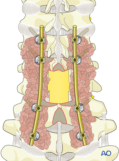 Pcf Surgery Posterior decompression and stabilization C3-C7 for Subaxial cervical ...