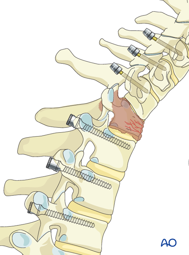 posterior decompression and stabilization c7 t1