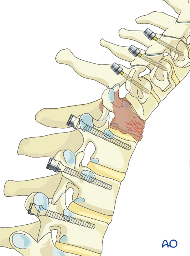 Posterior decompression and stabilization C7-T1 for Subaxial cervical ...