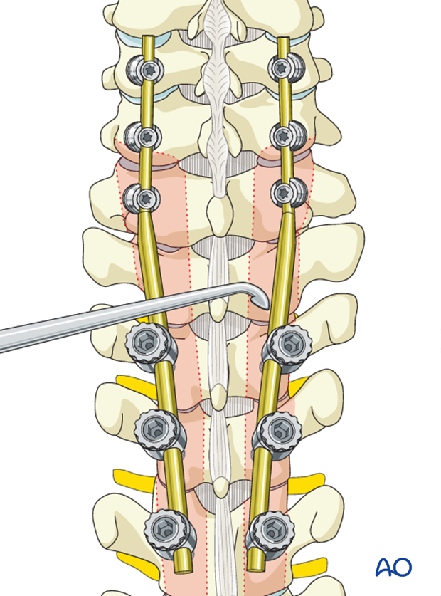 posterior stabilization c7 t1