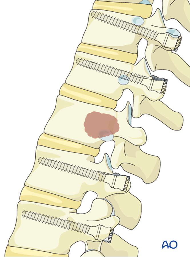 Posterior decompression and stabilization for Thoracolumbar, stable ...