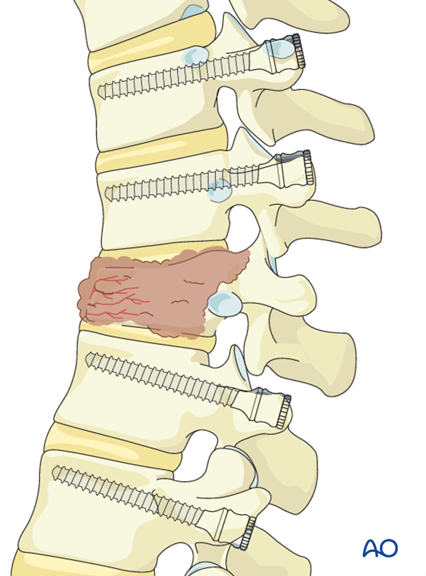 Thoracic and lumbar fractures: Posterior long segment fixation