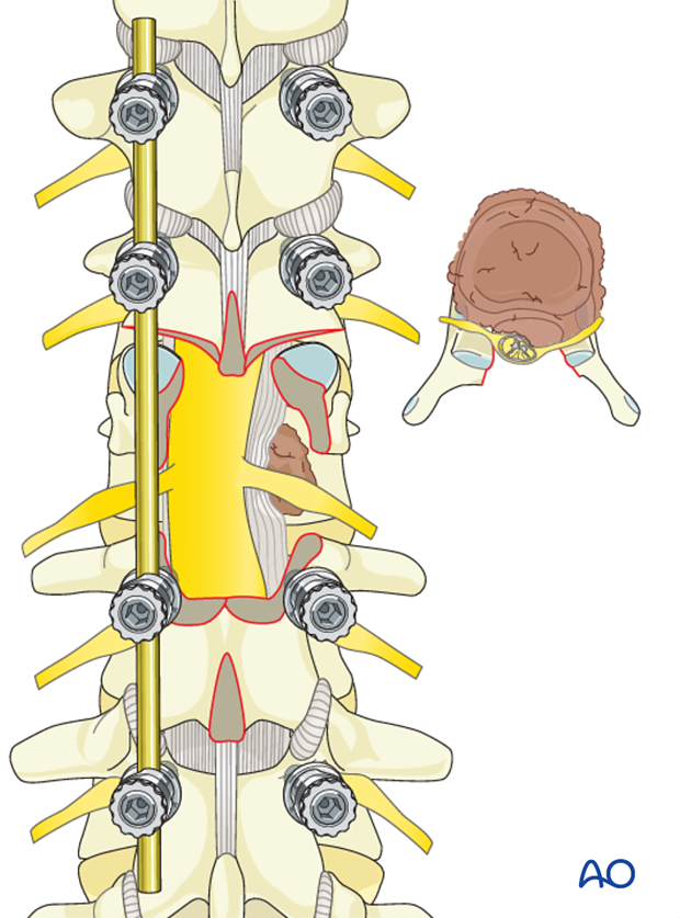 Thoracic and lumbar fractures: Posterior long segment fixation