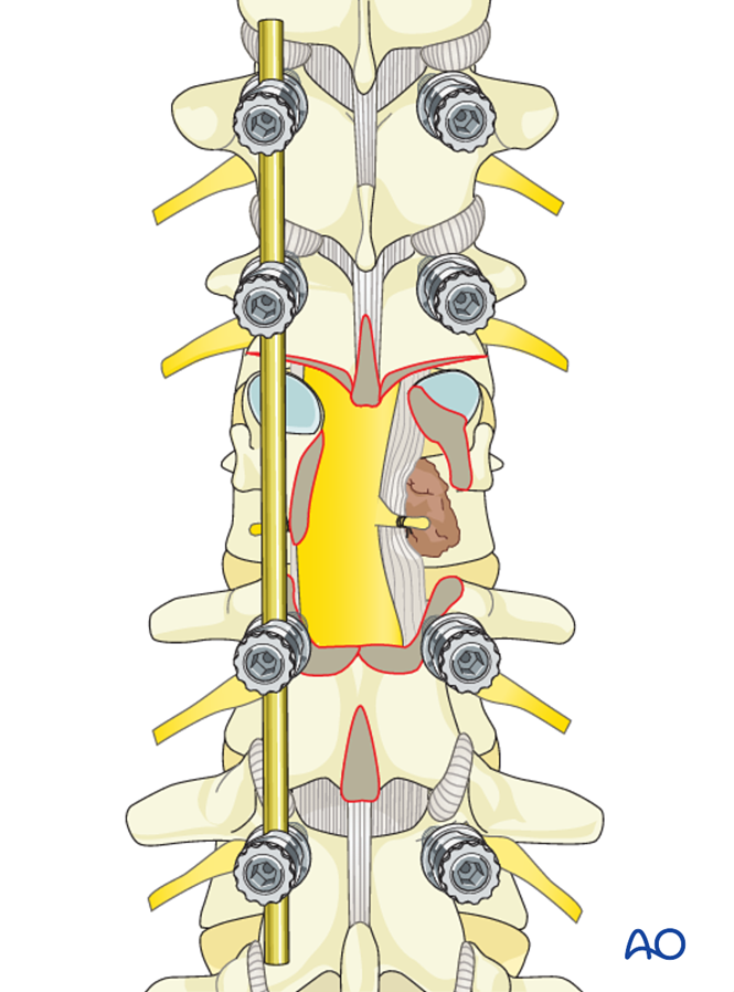 Posterior decompression and stabilization for Thoracolumbar, stable ...
