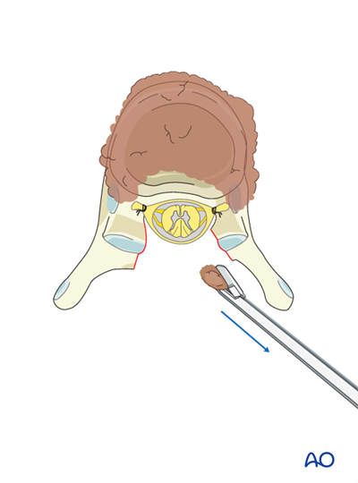 Relocated Compression Posterior decompression and stabilization for Thoracolumbar, unstable ...