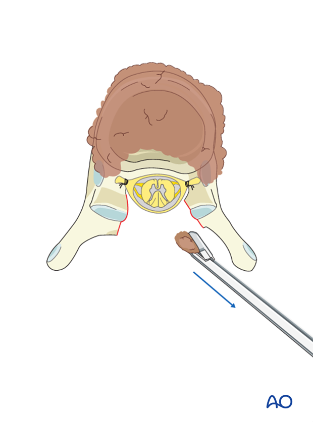 Thoracic and lumbar fractures: Posterior long segment fixation