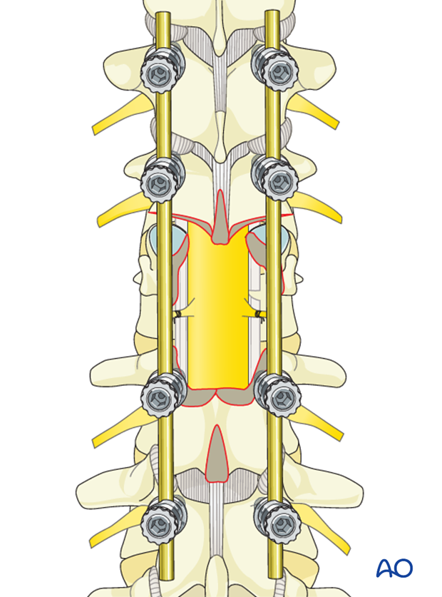 Thoracic and lumbar fractures: Posterior long segment fixation