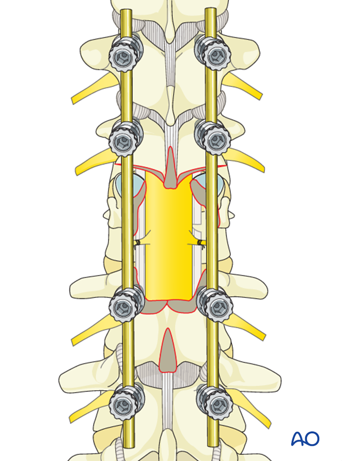 Posterior decompression and stabilization for Thoracolumbar, unstable ...