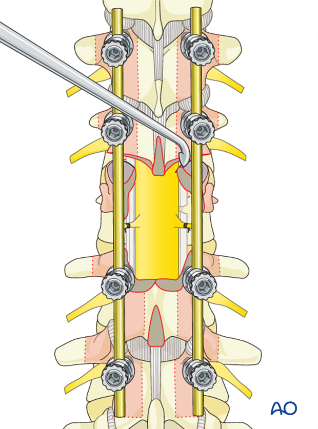 Thoracic and lumbar fractures: Posterior long segment fixation