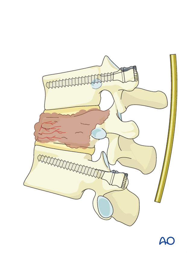 posterior mis