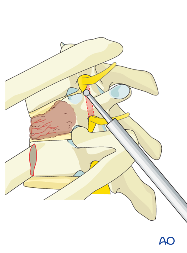 anterior corpectomy and stabilization