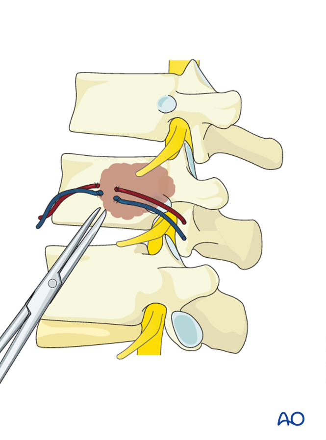 Anterior corpectomy and stabilization for Thoracolumbar, stable, high ESCC