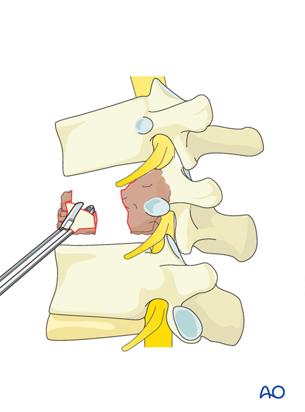 anterior corpectomy and stabilization